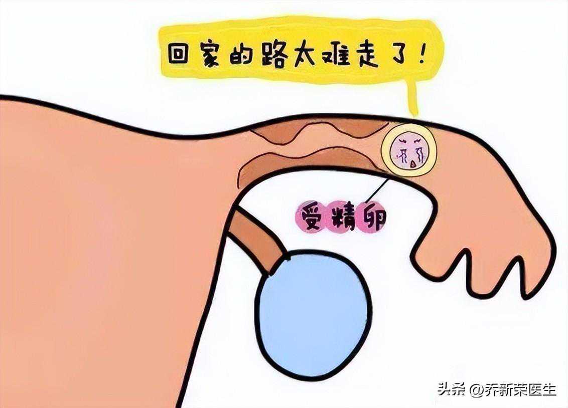 两年前经历了痛苦的宫外孕风险之后，现在她的备孕之路顺利吗